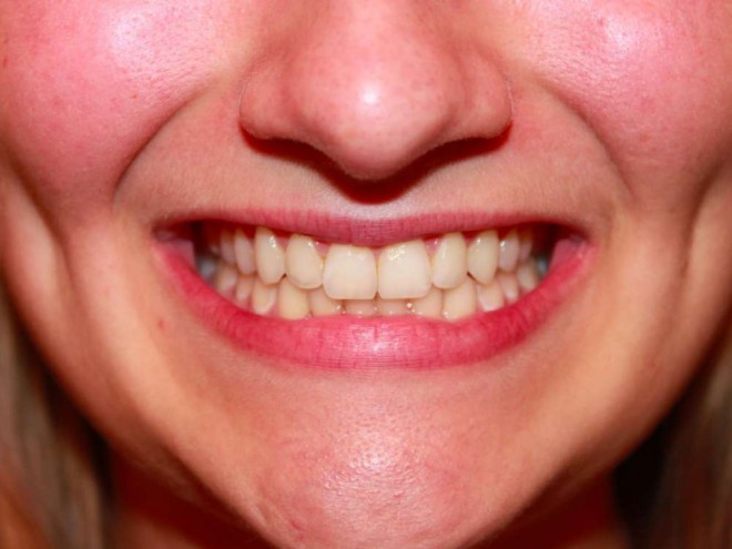 Perte de dents
