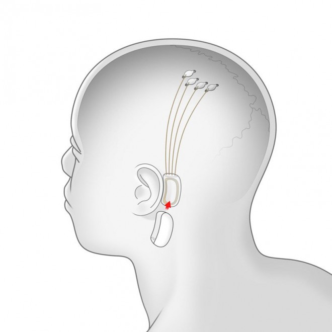 Neuralink