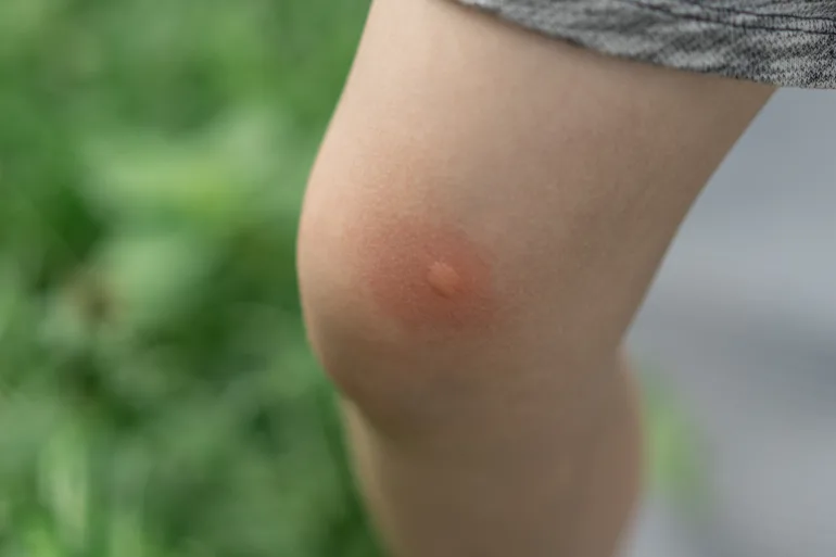 かゆみを止める